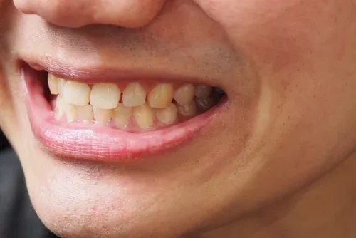 Combien de temps faut-il attendre après un repas pour se brosser les dents ?