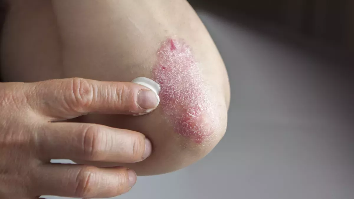 Psoriasis : comprendre les causes et les traitements de cette maladie inflammatoire