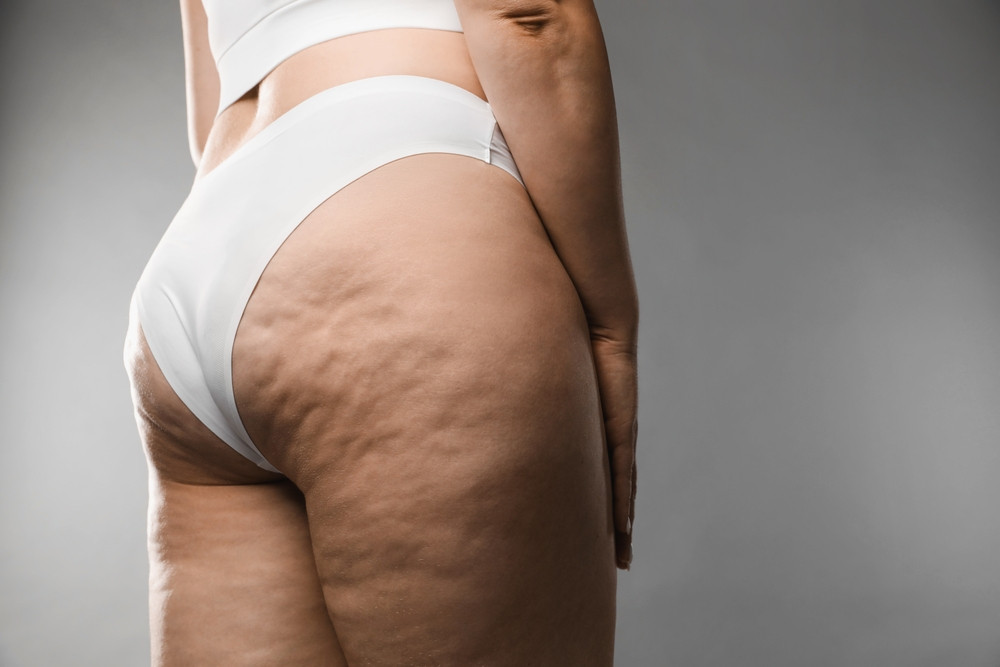 Cellulite : comment éliminer les capitons ?