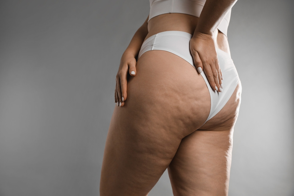 Cellulite : 10 aliments anti-capitons