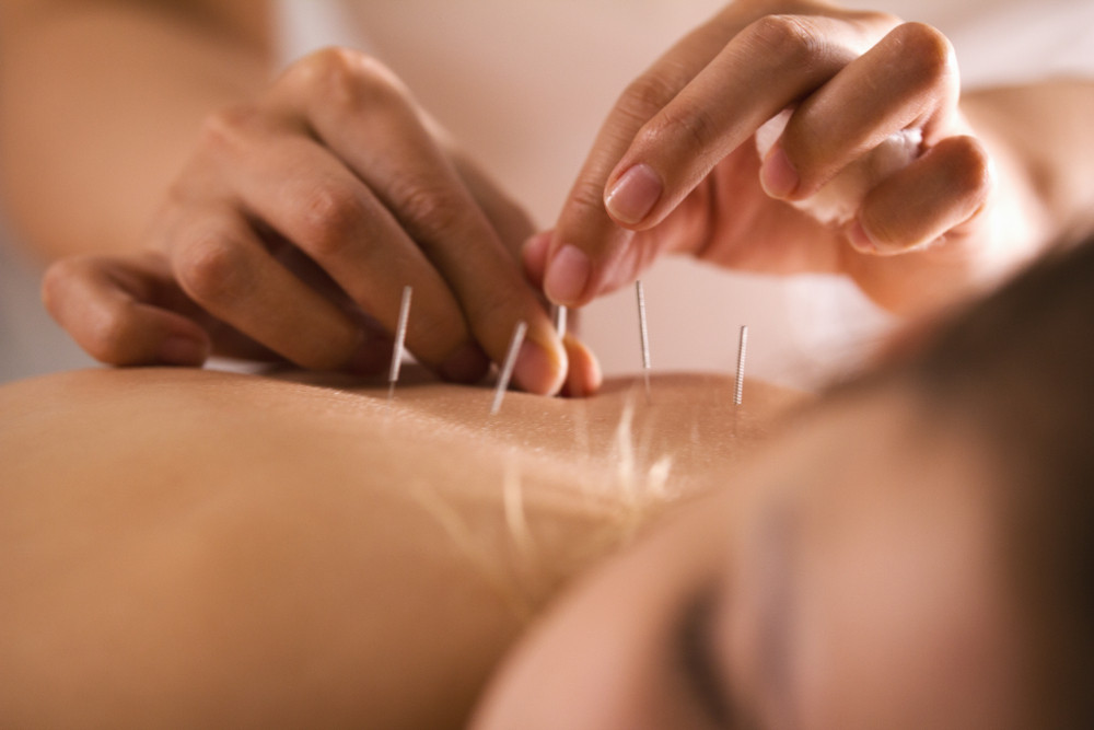 Tous les bienfaits de l'acupuncture