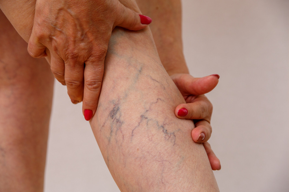 Comment se débarrasser des varices ?