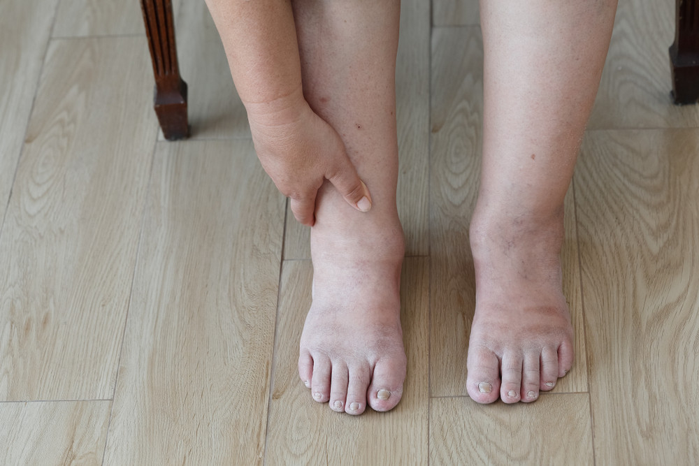 Pieds gonflés : quelles sont les causes ?