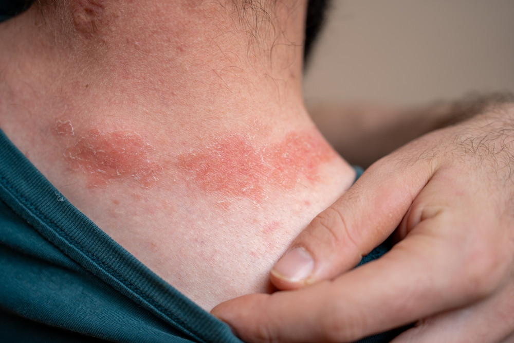 Qu'est-ce qui peut provoquer un psoriasis ?