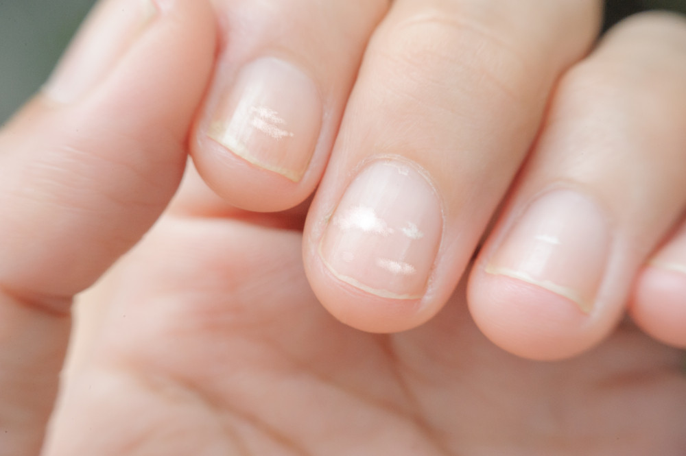 Que signifient les taches blanches sur les ongles ?
