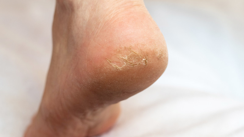 Comment soigner des pieds craquelés ?