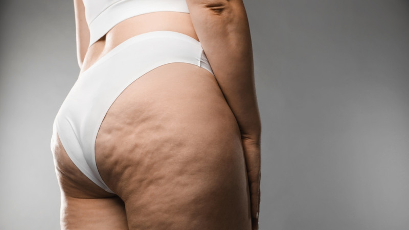 Cellulite : comment éliminer les capitons ?