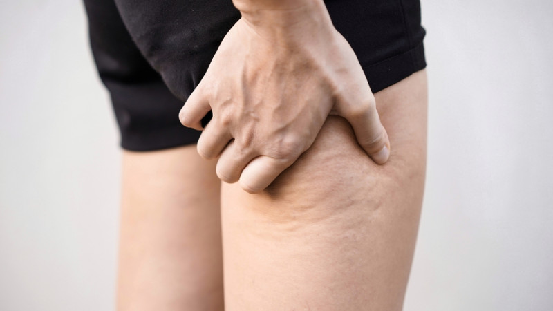 Madothérapie et cellulite : quel est le principe de cette nouvelle technique et est-ce efficace ?