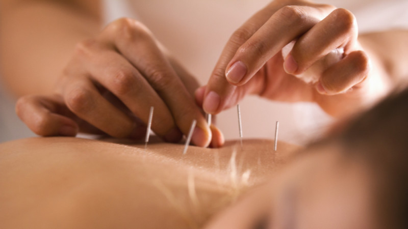 Tous les bienfaits de l'acupuncture