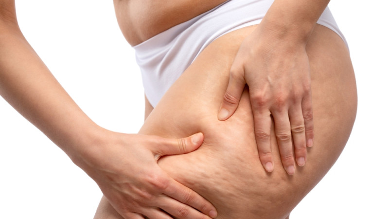 Cellulite : stratégies efficaces pour réduire son apparence