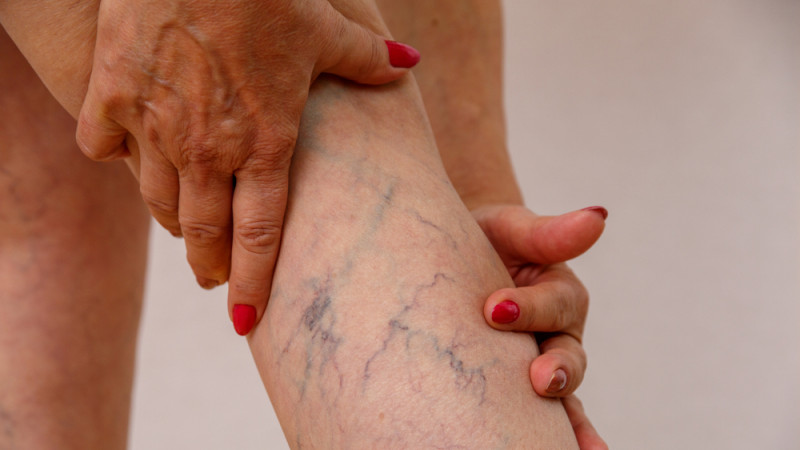 Comment se débarrasser des varices ?