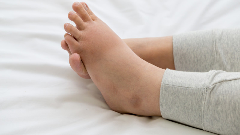 Comment soulager des pieds gonflés ?