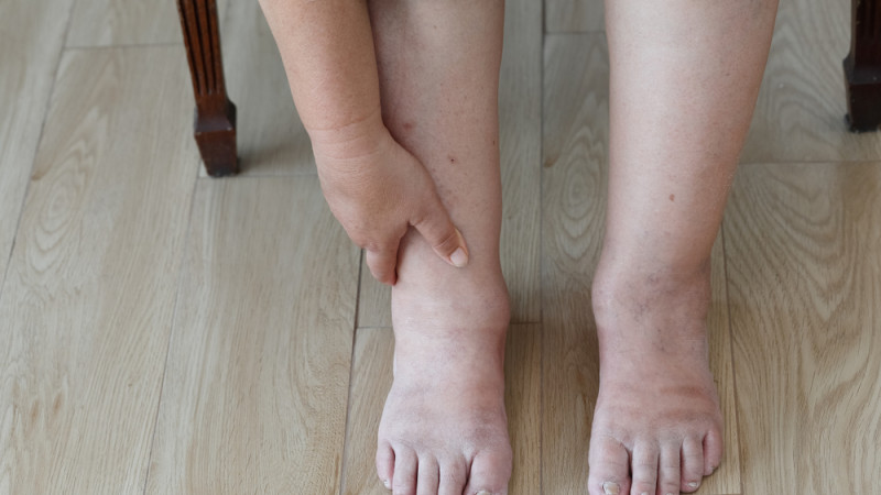 Pieds gonflés : quelles sont les causes ?