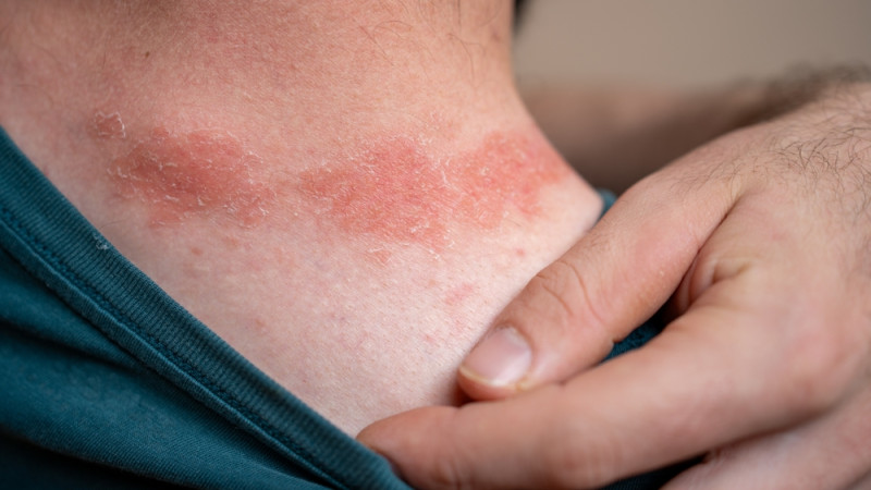 Qu'est-ce qui peut provoquer un psoriasis ?