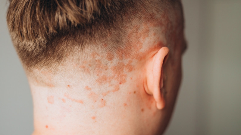 Comment débute un psoriasis ?