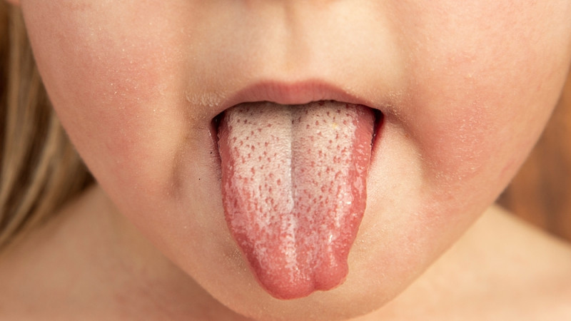 Comment soulager une scarlatine ?