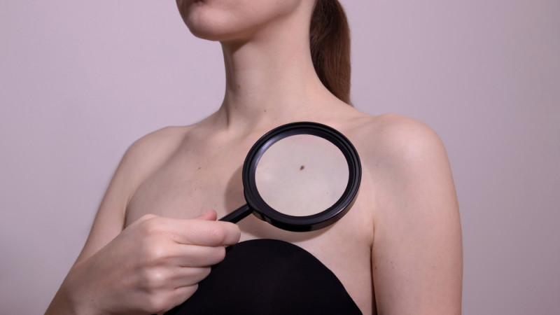 La règle ABCDE pour identifier un grain de beauté suspect