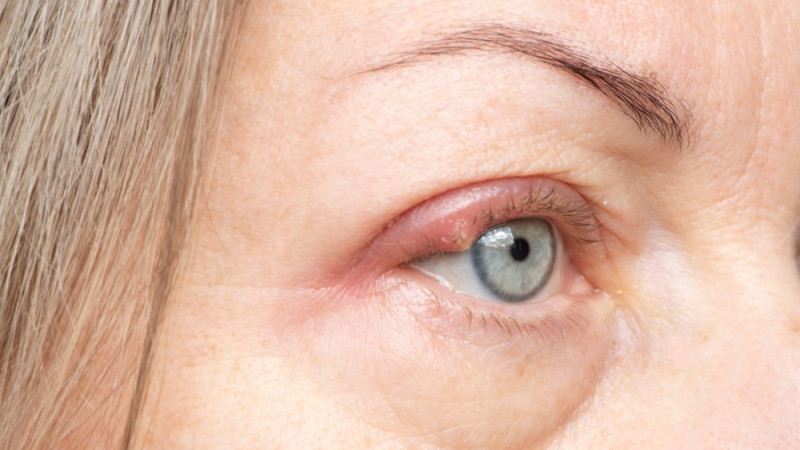 Comment soulager un orgelet à l’œil ?
