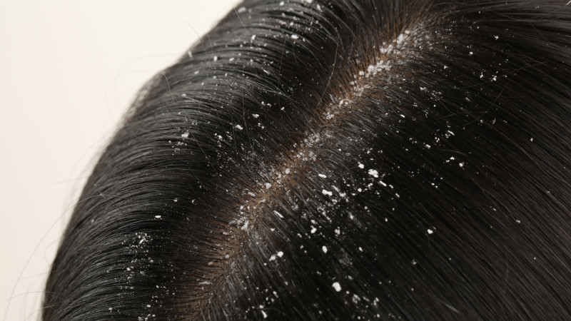 Pellicules persistantes : que faire ?