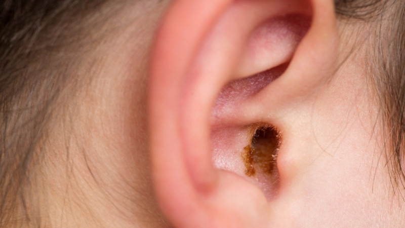 Comment enlever le cérumen de son oreille ?