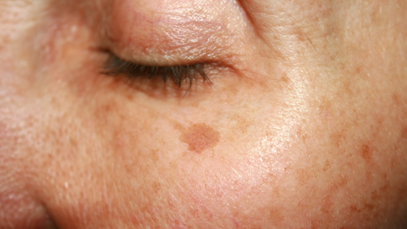 taches marrons sur la peau